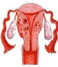 Adenomyosis és endometriosis - mi a különbség? Mi a különbség az endometriosis és az adenomyosis között?