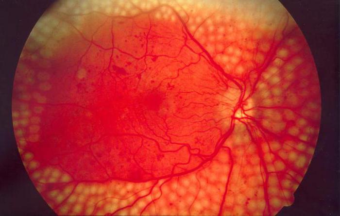 a retina angioszklerózisa az, ami az