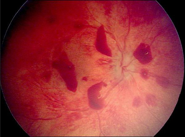 mindkét szem retinájának angioszklerózisa