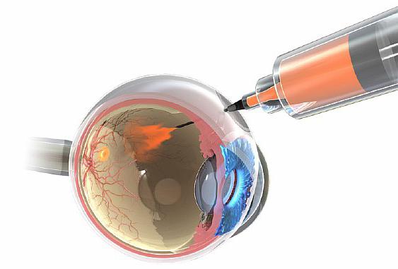 A retina makuláris degenerációja: okai és kezelése